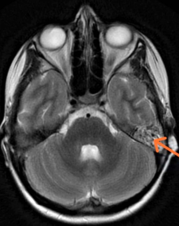 Resonancia magnética de cráneo ponderada en T2 en la que se observa alteración en la señal del ápex petroso izquierdo
