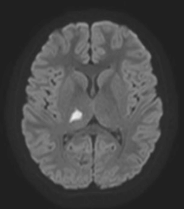 RM T2/FLAIR axial: hiperintensidad de unos 12 x 8 mm en tálamo derecho, sugestiva de infarto isquémico agudo.